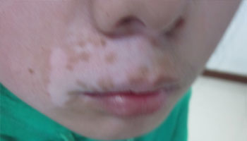 下巴有白斑照wood燈有可能誤診嗎