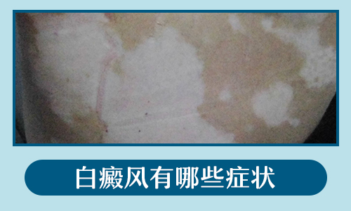 胸口處有很多的白點現在成片了怎么辦