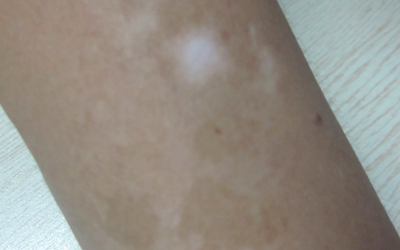 手臂有許多白點形成一片怎么辦