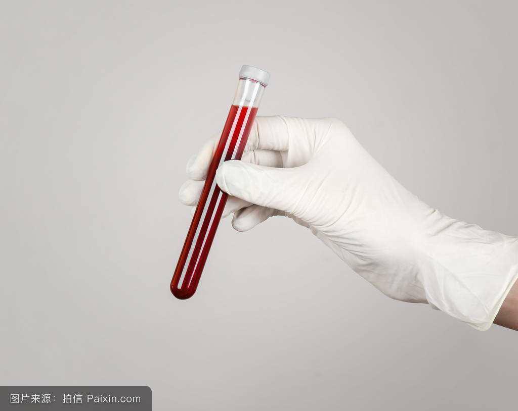 抽血檢查怎么看是不是白癜風