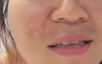 長期美容臉上長了一片白是白癜風嗎