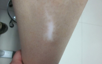 怎樣能分辨身上出現(xiàn)的白斑是不是白癜風(fēng)