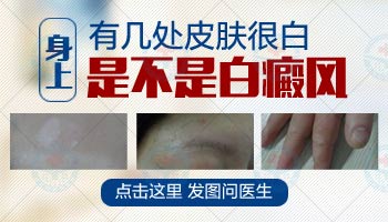 怎么辨別白斑是不是白癜風(fēng)早期癥狀