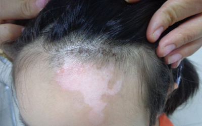 頭上有一塊白斑是什么怎么確診