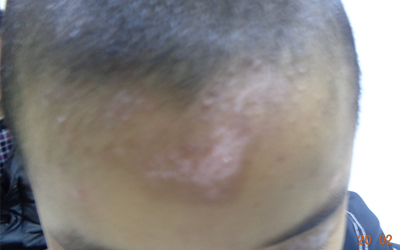 額頭有一點點白點不知道是不是白癜風？