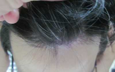 額頭起白點點怎么回事