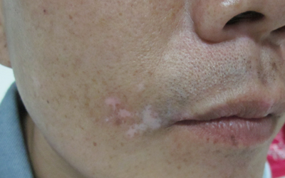 嘴巴邊上白了一塊