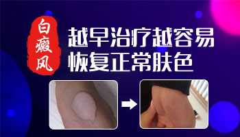 孩子左邊臉上為什么有一塊皮膚很白是白癜風嗎