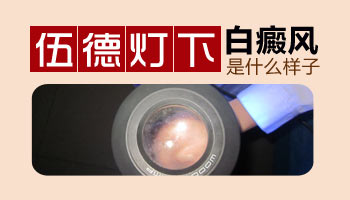 伍德燈下的各種白斑圖片