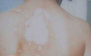 皮膚燙傷留下的白斑可能是白癜風嗎