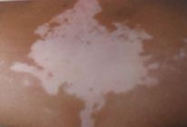 <a href=http://m.xvxgx.cn/ target=_blank class=infotextkey>石家莊白癜風(fēng)醫(yī)院</a>白癜風(fēng)臨床表現(xiàn)