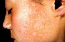 石家莊兒童白癜風有哪些癥狀呢?