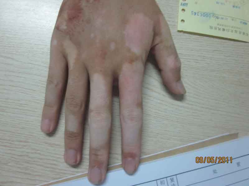 白癜風(fēng)初期的癥狀是什么