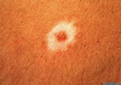 暈痣型白癜風癥狀有什么特點?