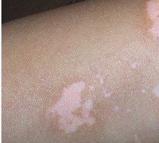 白癜風發病早期有哪幾種癥狀?