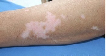 臨床上白癜風初期癥狀都有哪些表現