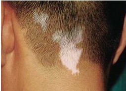 白癜風的早期癥狀一般的有什么呢