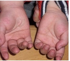 手部白癜風患者手指會出現脫皮嗎？