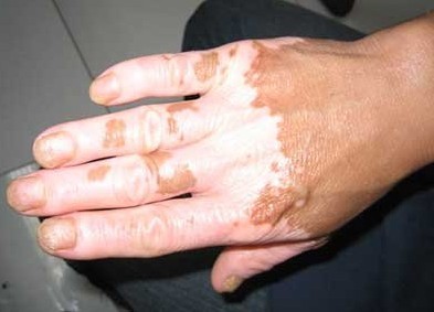 普通的皮膚白斑與白癜風(fēng)有什么區(qū)別?