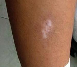 石家莊遠大白癜風醫院 成人白癜風的早期癥狀有哪些？