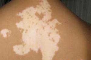 泛發(fā)型白癜風(fēng)的癥狀有哪些?