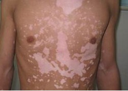 胸部白癜風的臨床表現有哪些