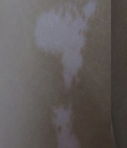 白癜風初發都有哪些癥狀表現