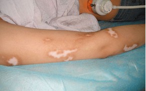 雙臂白癜風癥狀