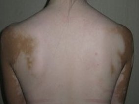 石家莊白癜風專家出招辨認泛發型白癜風的疾病癥狀