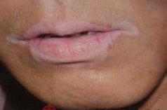 [CropImg]唇部白癜風(fēng).jpg