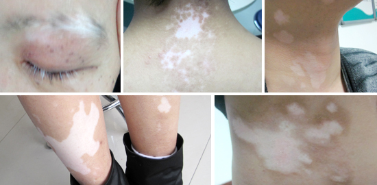 白癜風(fēng)初期的癥狀是怎么樣的