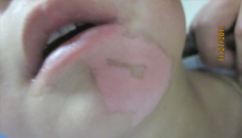 初期白癜風發病都有哪些癥狀