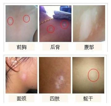 早期白癜風癥狀普及了