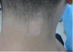 白癜風白斑的顏色與病情有什么關系