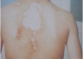 白癜風癥狀圖是什么樣