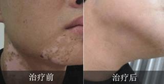 臉上出現(xiàn)白癜風(fēng)早期有什么特點(diǎn)