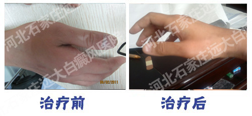 雙手都患上了白癜風 這如何治療呢？