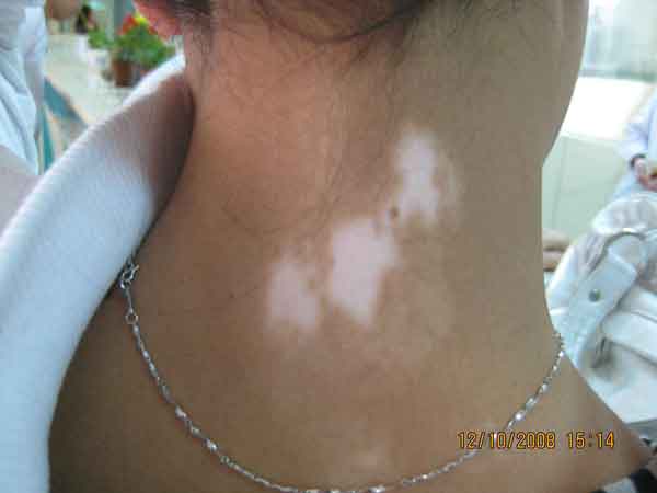 散發型白癜風激光治療能治好嗎