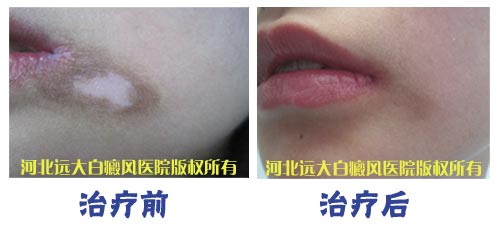 <a href=http://m.xvxgx.cn/ target=_blank class=infotextkey>石家莊白癜風醫院</a>臉上患有白癜風應該如何治療好