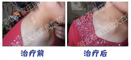 邯鄲復興區白癜風治療用什么方法好?