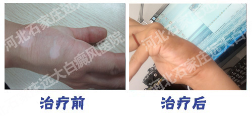 曲周縣治療白癜風哪家醫(yī)院好?