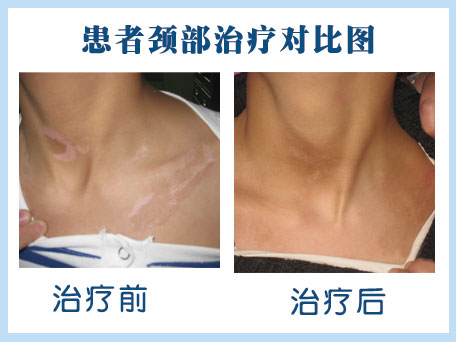 白癜風治療哪種效果比較好
