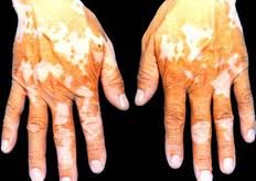 手背白癜風如何治療?