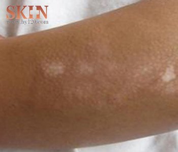 白癜風患者如何進行準確的自我診斷?