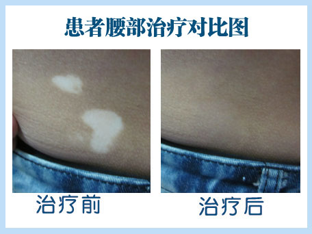 白癜風治療效果好的療法