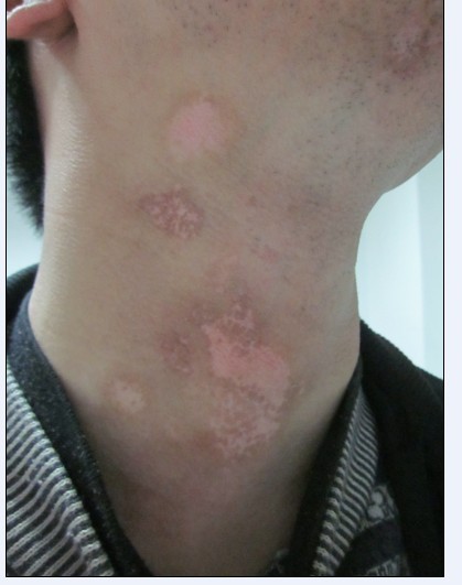 白癜風(fēng)患者出現(xiàn)皮膚過敏要怎么辦?