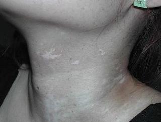 怎么治療局限性白癜風才不會擴散