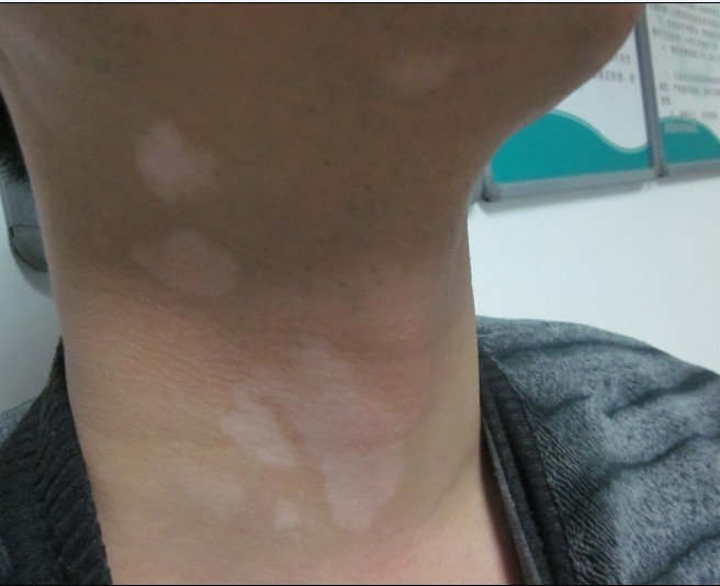 節段型白癜風早期癥狀有什么?