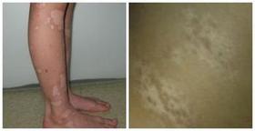 秋季黑色素種植治療白癜風的效果好嗎?