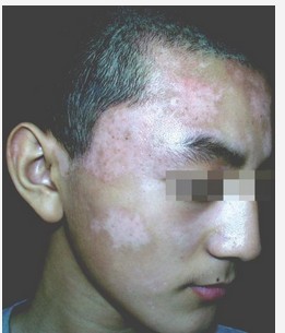 青少年缺少微量元素引起的白癜風如何治效果好?